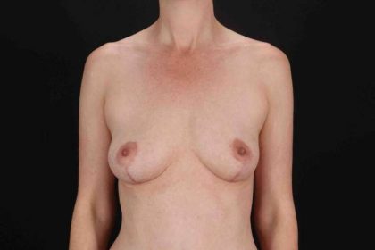 Breast Augmentation with Fat Transfer Before & After Patient #806