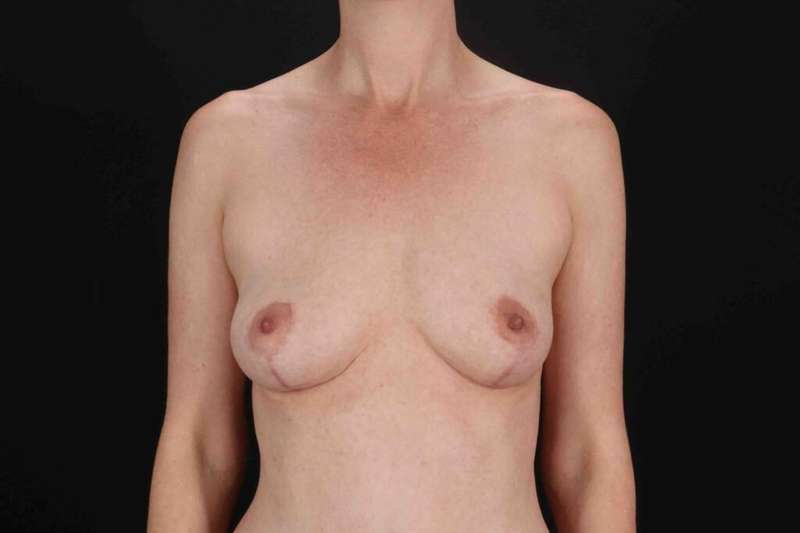 Breast Augmentation with Fat Transfer Before & After Patient #806