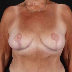 Breast Reduction with Lift Before & After Patient #1016