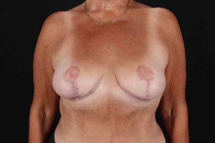 Breast Reduction with Lift Before & After Patient #1016