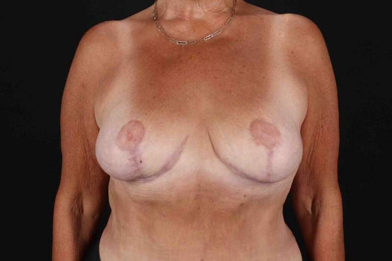 Breast Reduction with Lift Before & After Patient #1016