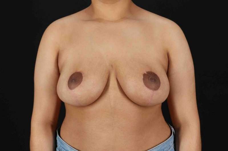 Breast Reduction with Lift Before & After Patient #1027