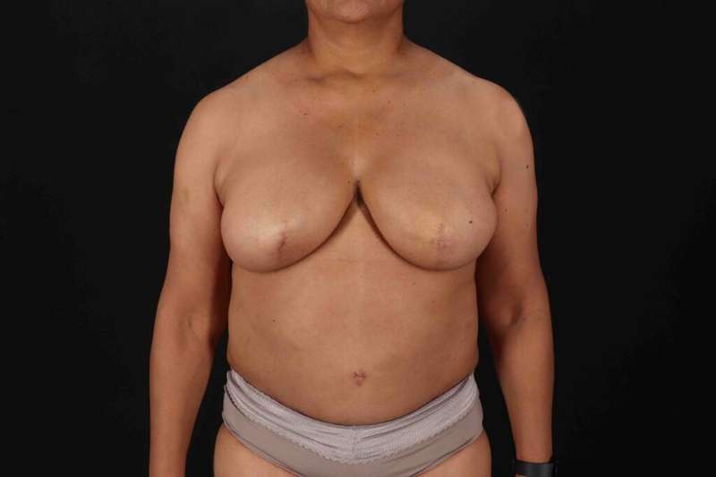 Breast Reconstruction Before & After Patient #1038