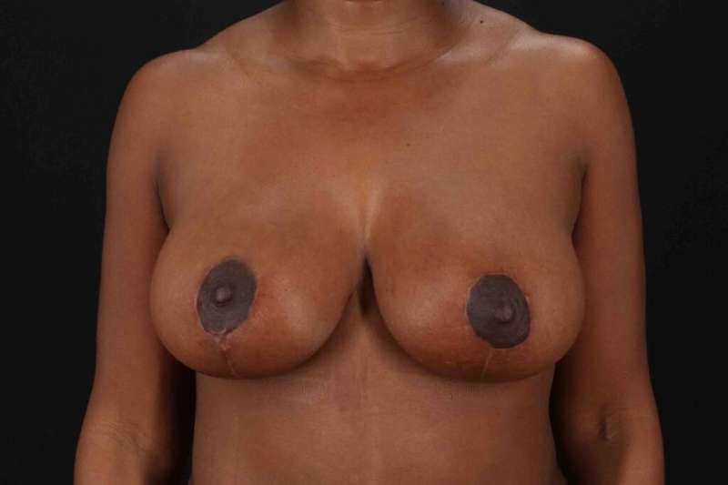 Breast Lift Before & After Patient #1049