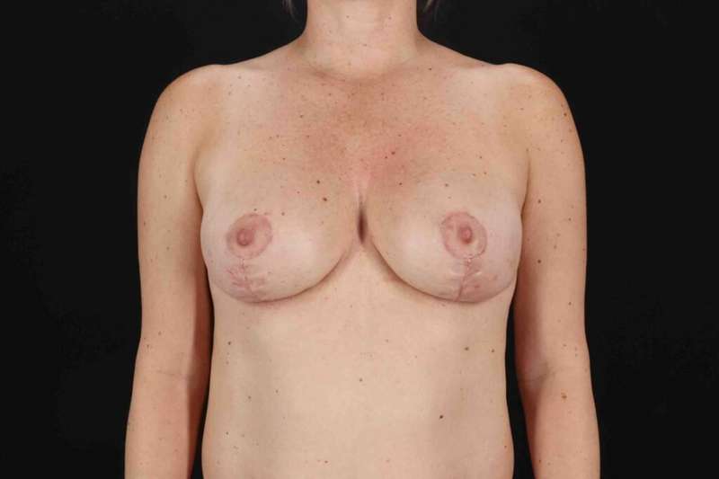 Breast Lift Before & After Patient #1071