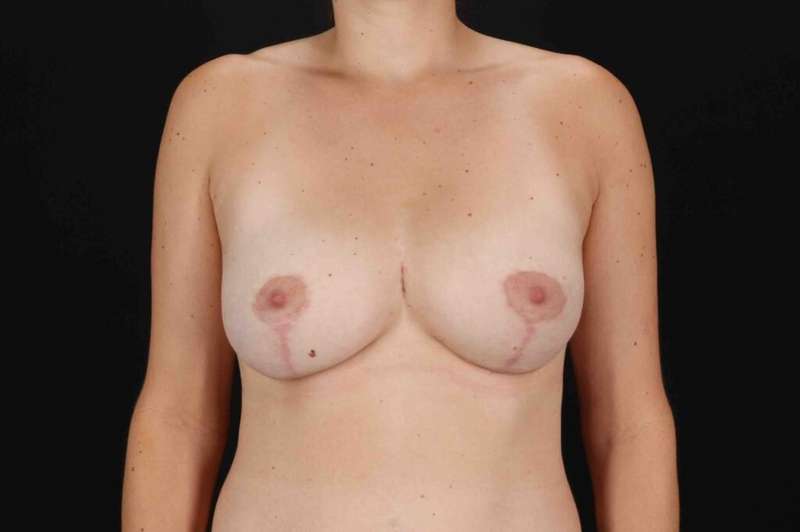 Breast Lift Before & After Patient #1104