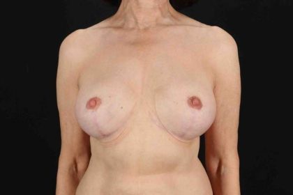 Breast Augmentation with Fat Transfer Before & After Patient #817