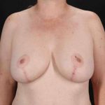 Breast Lift Before & After Patient #1115