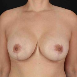 Breast Lift Before & After Patient #1148