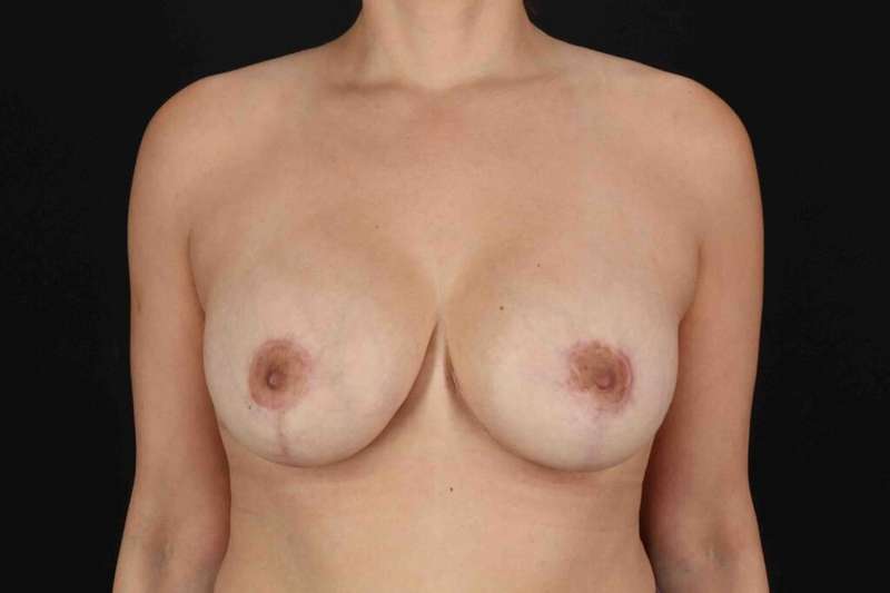 Breast Lift Before & After Patient #1148