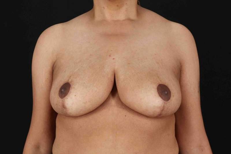 Breast Lift Before & After Patient #1159