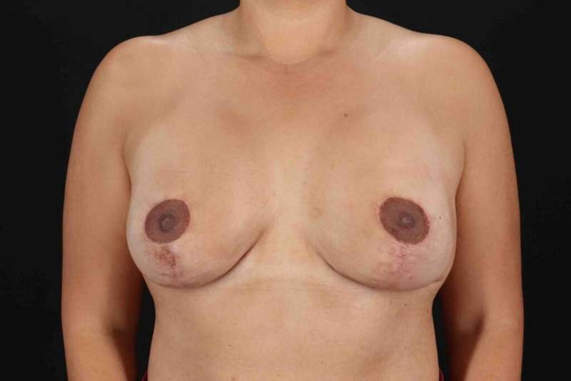 Breast Augmentation with Implants Before & After Patient #1214