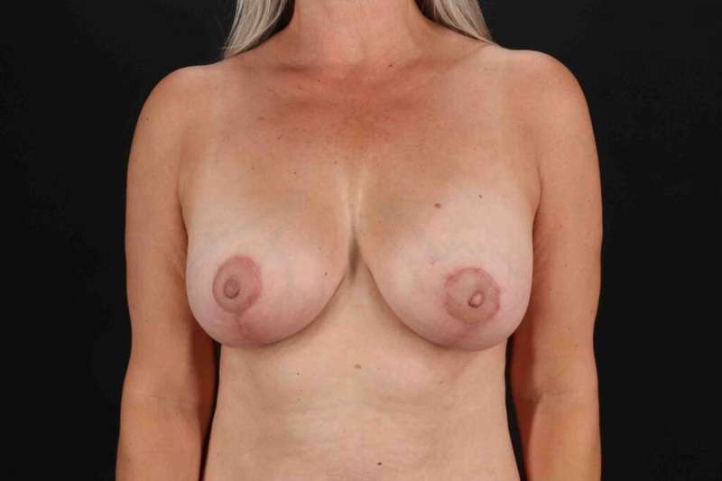 Breast Augmentation with Implants Before & After Patient #1225