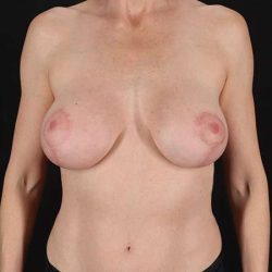 Breast Augmentation with Implants Before & After Patient #1236