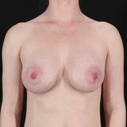 Breast Augmentation with Implants Before & After Patient #1247
