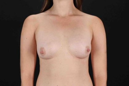 Breast Augmentation with Fat Transfer Before & After Patient #784