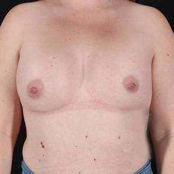 Breast Augmentation with Implants Before & After Patient #1258