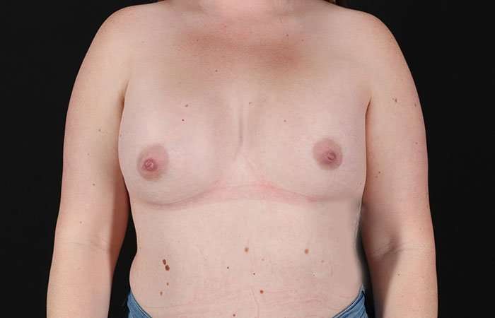 Breast Augmentation with Implants Before & After Patient #1258