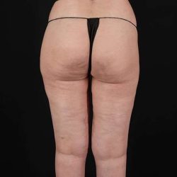 Cellulite Treatment Before & After Patient #1272