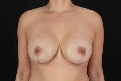 Implant Revision Before & After Patient #839