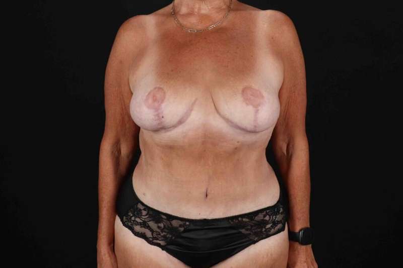 Mommy Makeover Before & After Patient #1353