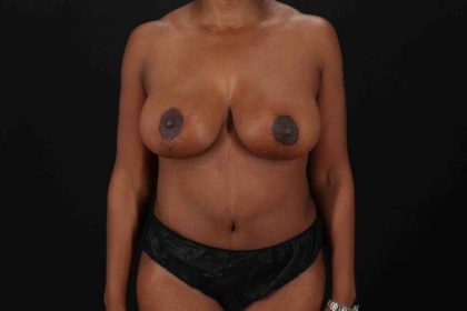 Liposuction Before & After Patient #1377