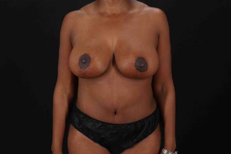 Tummy Tuck Before & After Patient #1451