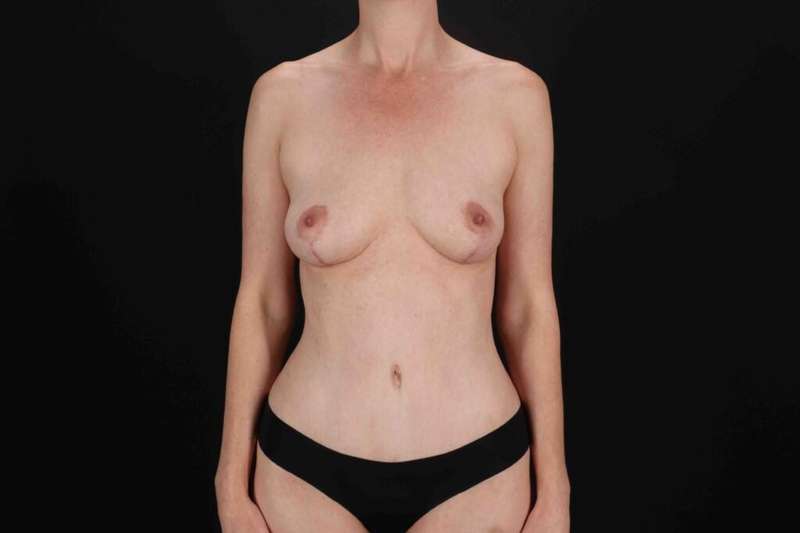 Tummy Tuck Before & After Patient #1491