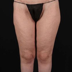 Thigh Lift Before & After Patient #1533