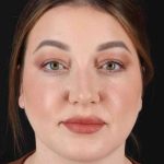 Chin Augmentation Before & After Patient #1555