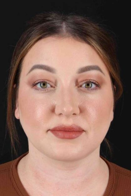 Chin Augmentation Before & After Patient #1555