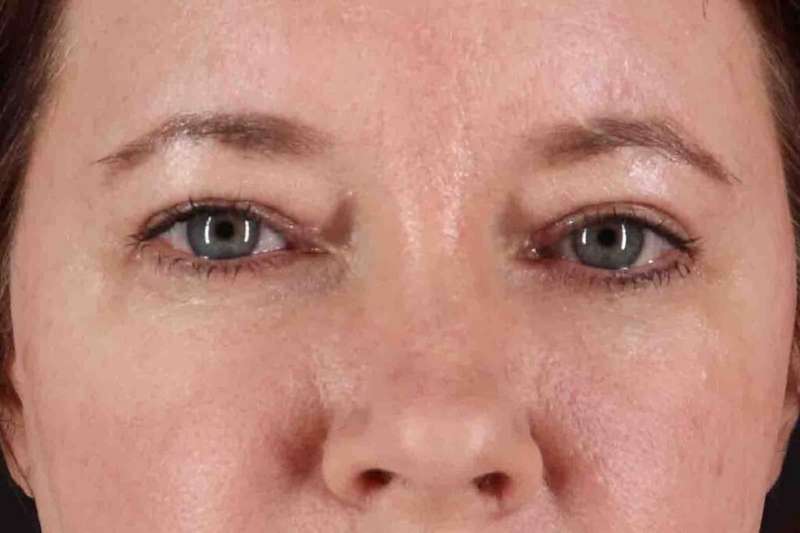 Brow Lift Before & After Patient #1566