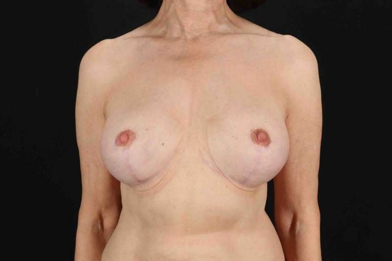 Breast Implant Removal Before & After Patient #861