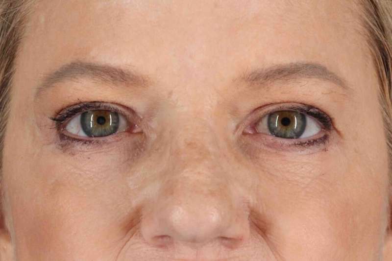 Brow Lift Before & After Patient #1577