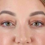 Brow Lift Before & After Patient #1588