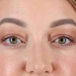 Brow Lift Before & After Patient #1588