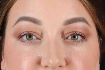 Brow Lift Before & After Patient #1588