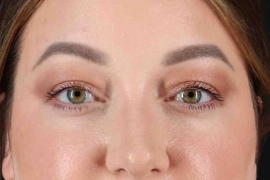 Brow Lift Before & After Patient #1588