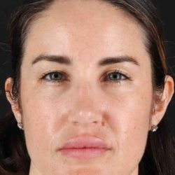 Brow Lift Before & After Patient #1599