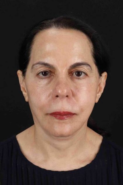 Face Lift Before & After Patient #1621