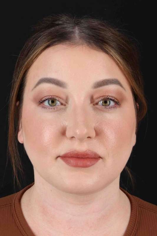 Face Lift Before & After Patient #1654