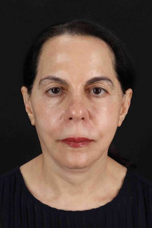 Neck Lift Before & After Patient #1687
