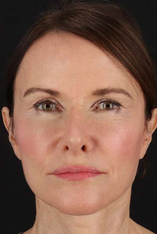 Neck Lift Before & After Patient #1698