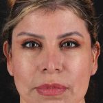 Neck Lift Before & After Patient #1709