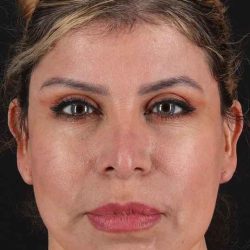 Neck Lift Before & After Patient #1709