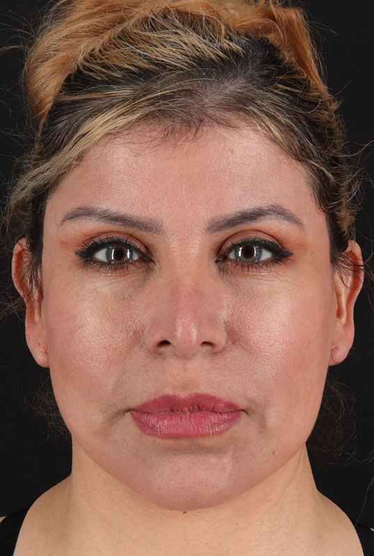 Neck Lift Before & After Patient #1709