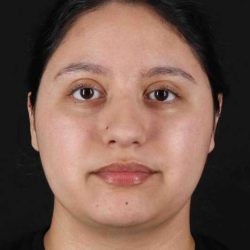 Neck Liposuction Before & After Patient #1753