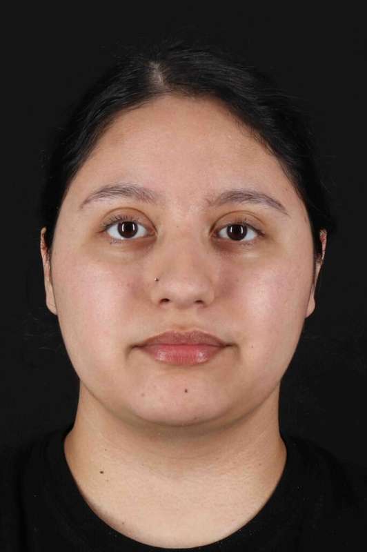 Neck Liposuction Before & After Patient #1753