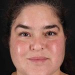 Neck Liposuction Before & After Patient #1775