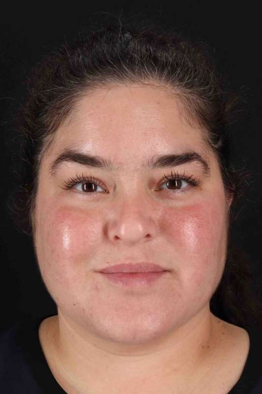 Neck Liposuction Before & After Patient #1775